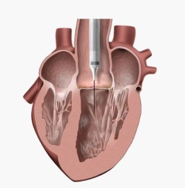 TAVR Step 1