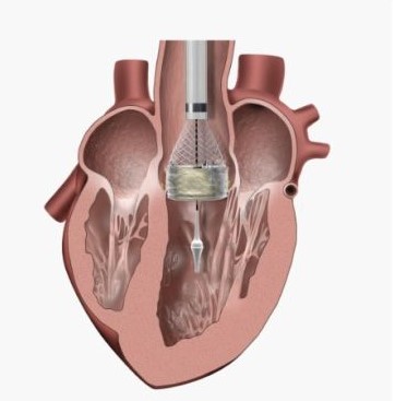 TAVR Step 2