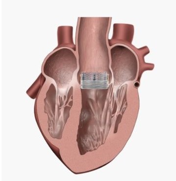 TAVR Step 3
