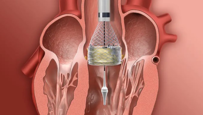 Houston Methodist Willowbrook now offers minimally invasive TAVR procedure, providing faster recovery for patients with heart valve disease