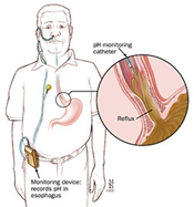 24-hour pH/Impedance reflux monitoring