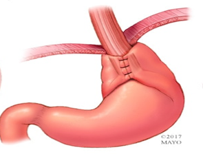 NISSEN FUNDOPLICATION