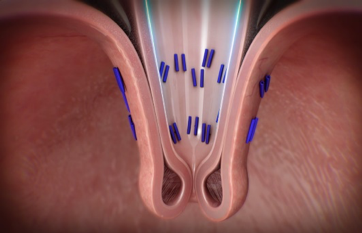 TIF (Transoral Incisionless Fundoplication)