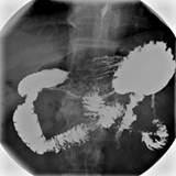 Upper Gastrointestinal Series