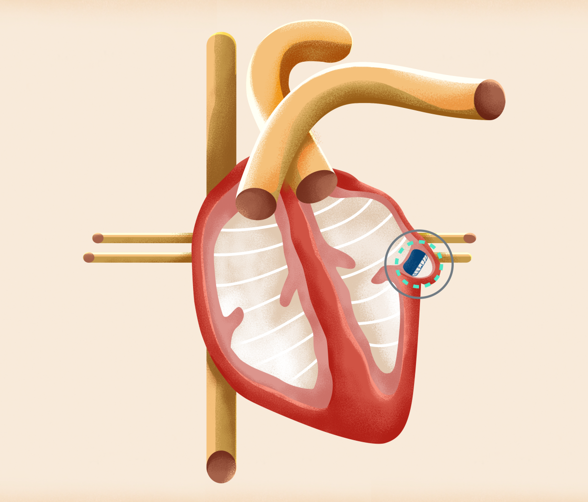 WATCHMAN Heart Diagram